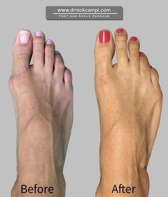 Bunion Surgery