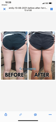 Cryo Body Sculpting and Cryo Body slimming