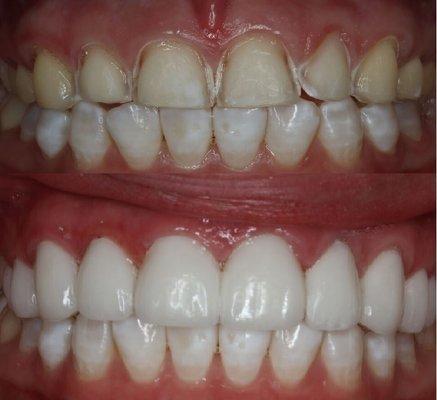 Patient before & after
 (set of 10 upper veneers)