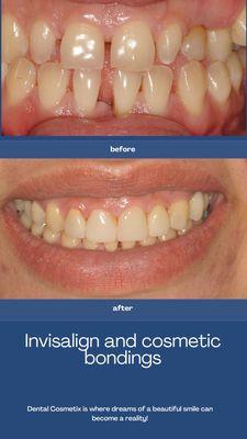 This patient had Invisalign  and then cosmetic bonding to build up the shape and contour of her teeth yielding a beautiful smile!