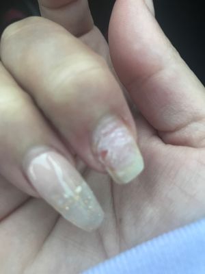 She took off a chunk of my nail