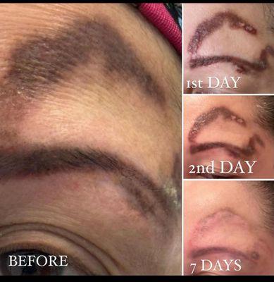 Tattoo removal on a botched eyebrow job. 
Picture shows results after just one session! Wow