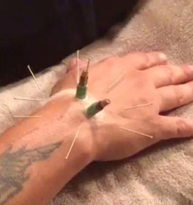 Moxibustion + needliing for a ganglion cyst