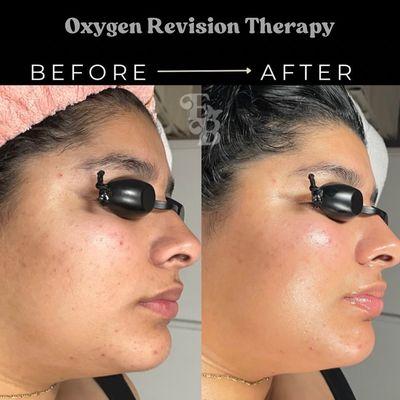 Oxygen revision therapy facial