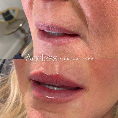 Ageless Lip Filler Results