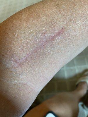 My scar after surgery, from having a case of beer tossed on my arm while visiting their drive thru.