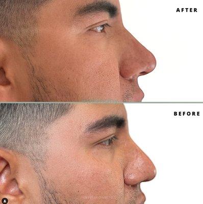 Liquid Rhinoplasty using Restylane filler.