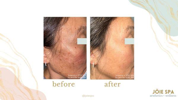 Removal of hyperpigmentation and sun damage at JOIE SPA