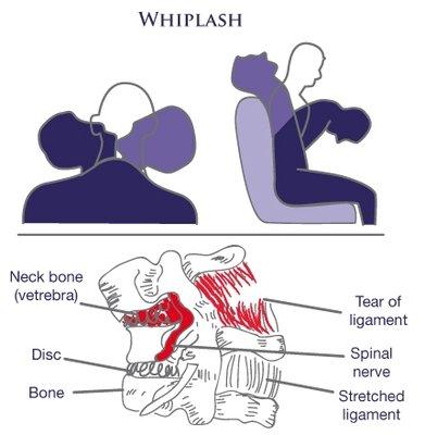 If your neck hurts after a car accident, you should be concerned with the slippage from the tissue tears will cause in long term troubles.