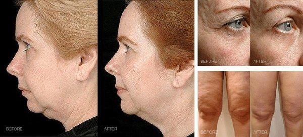 RF Laser Skin Tightening