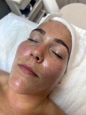 After: Red Carpet Facial