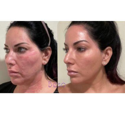 Venus Viva RF Micro-needling treatment before & after 3 sessions.