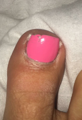 6 days after pedicure. cracked and gross