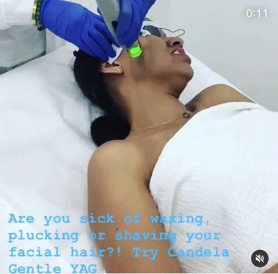 Laser Hair Removal -- Face