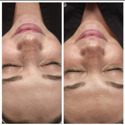 Hydrafacial before and after