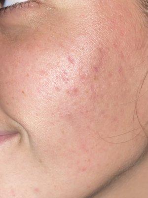 After 2 Laser Active Acne Treatments.