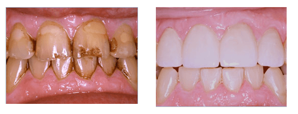 Patient's teeth were breaking down & had excessive stain due to smoking. Lower teeth were whitened and 4 all ceramic crowns w...