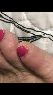 Here's my poor pinky toe- same foot as the big toe injury. The nail has been cut into and off. This is a phot from the same day of pedi.