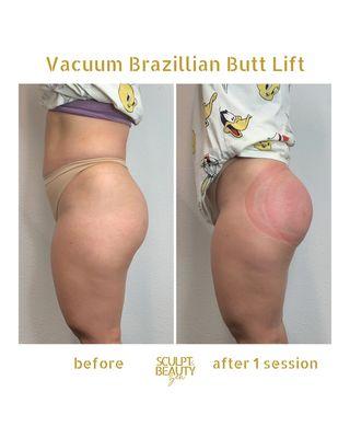 Vacuum Butt Lift Cupping