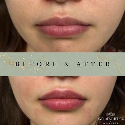 Before and After Lip Filler at Amy Aesthetics & Wellness