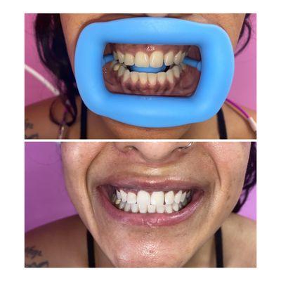 Teeth Whitening!