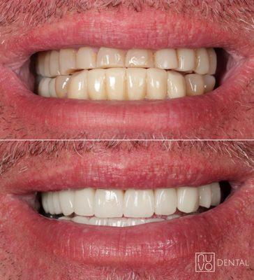 Transforming Smiles, One Perfect Curve at a Time 
A special one for a very special patient