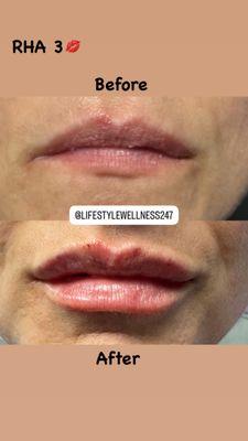 Lip filler with RHA 3