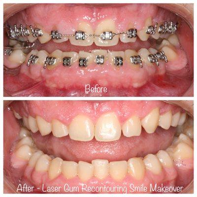 Laser Gum Contouring Smile Makeover