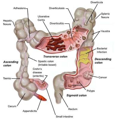 What an unhealthy colon can look like.