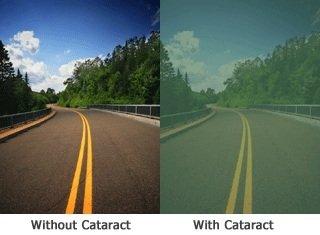 vision without a cataract