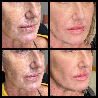 Filler injections for full face rejuvenation