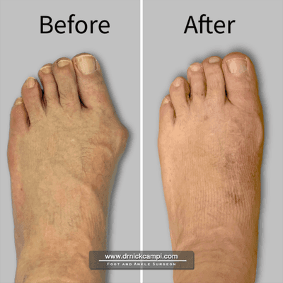 Reconstructive Bunion Surgery