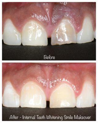 Smile Makeover with Internal Tooth Whitening