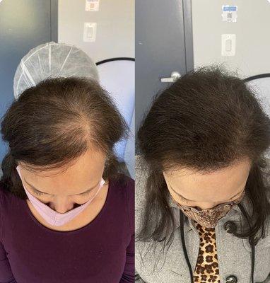 Scalp micropigmentation for women's alopecia areata. Before and after treatments by Edge Scalp Ink in Bethesda, Maryland.