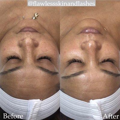 Before and After Antioxidant, Anti-aging Facial