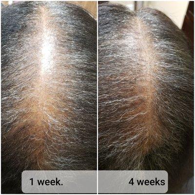 Hair Restoration