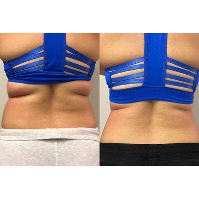 Body Contouring with 4 sessions! 2 1/2 inches lost!