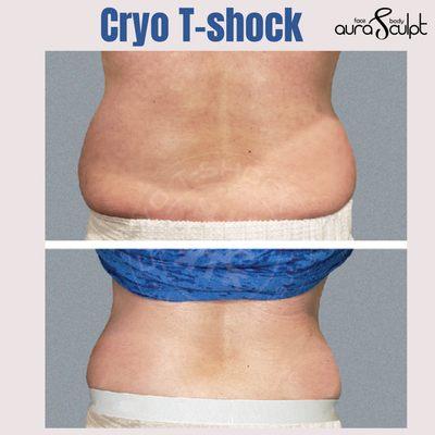 Cryo T-Shock