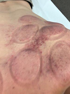 Looks super gross but the treatment (cupping technique) really works wonder