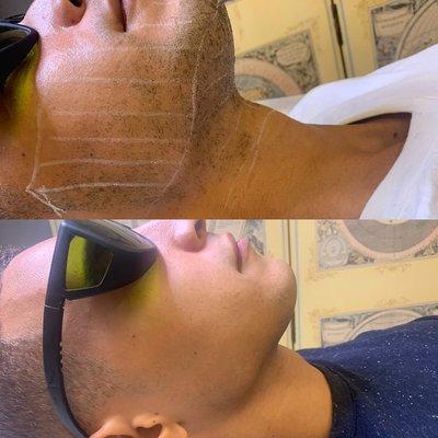 Laser hair removal before and after