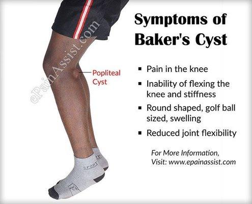 Baker's Cyst. * quiste de panadero