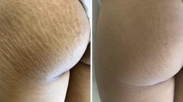 Stretch Mark Camouflage Before and After