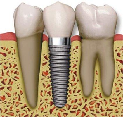 Implant placement and restoration