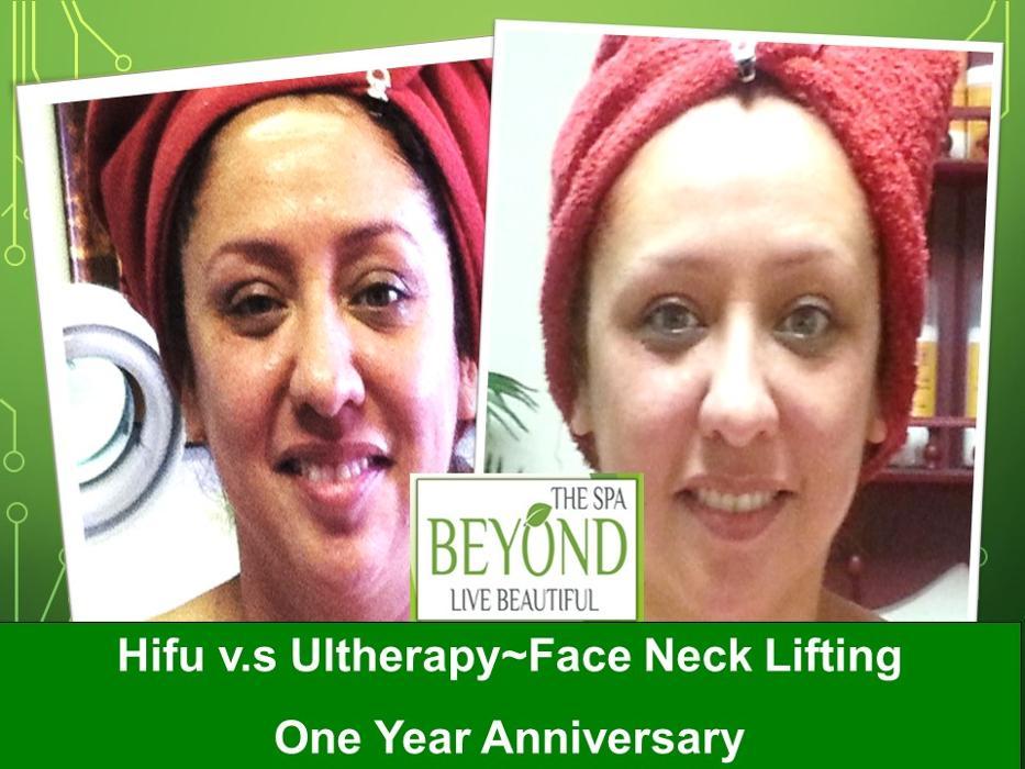 Beyond The Spa is #1 Specialized in HIFU-Ultherapy Trail: $499